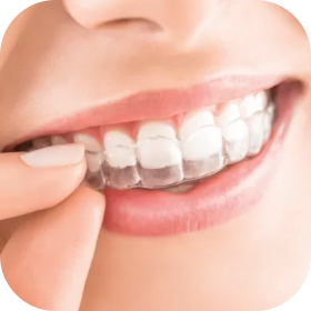 Serviço alinhadores invisiveis